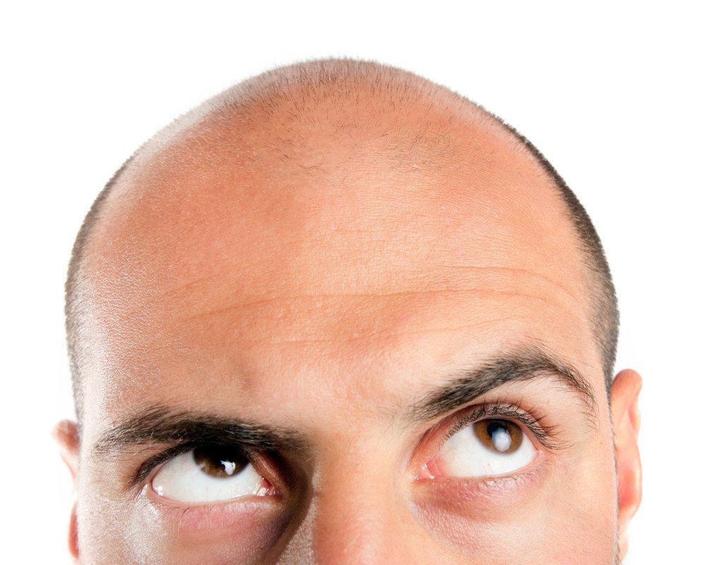 Hair Loss in Men