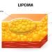 lipoma