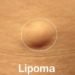 lipoma