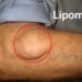 lipoma